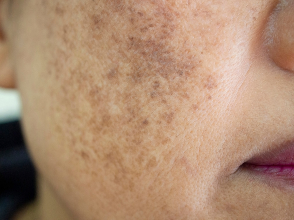 melasma.jpg
