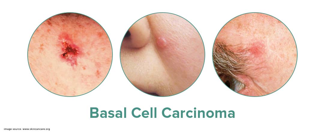 Basal Cell Carcinoma