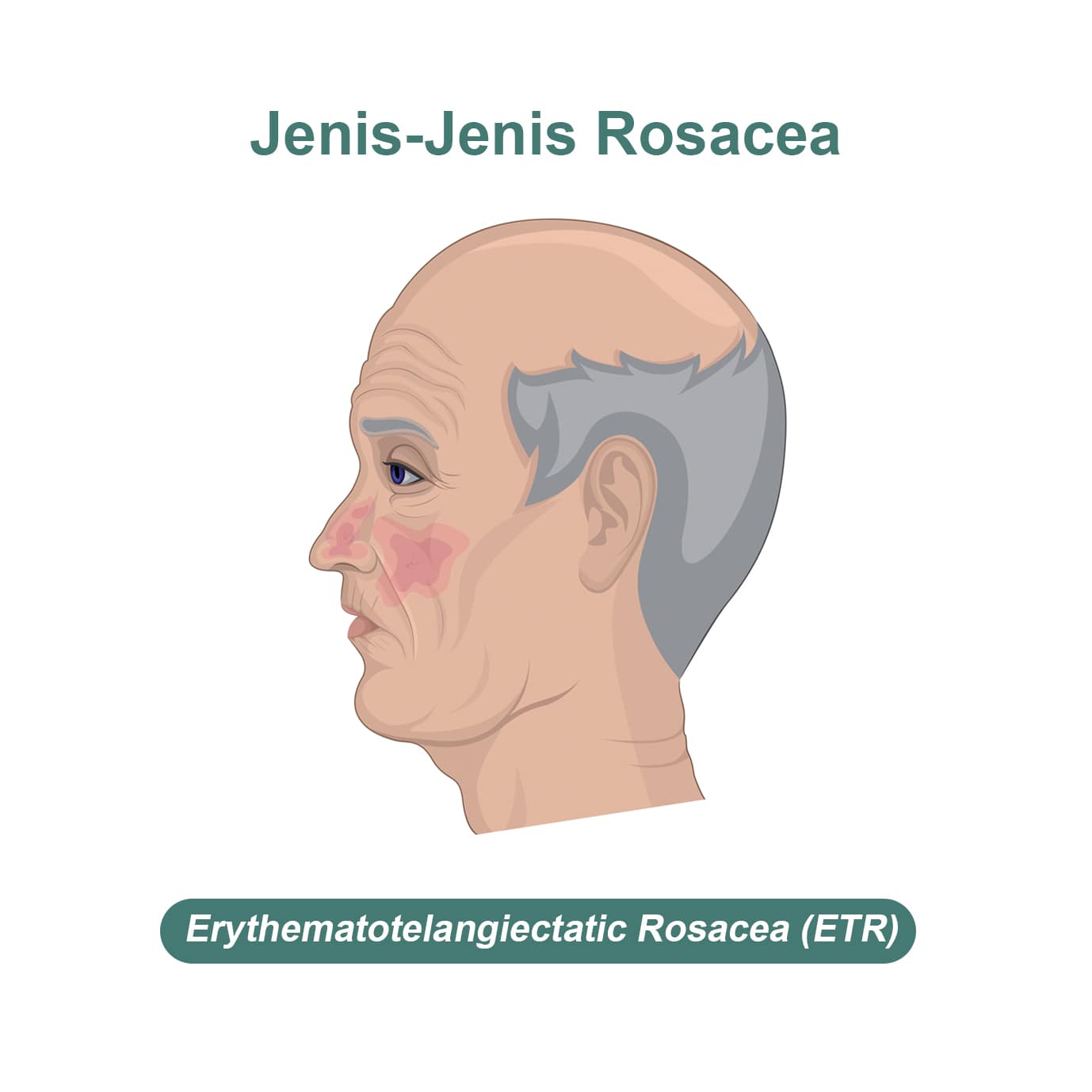 Jenis rosacea - erythematotelangiectatic rosacea (ETR)