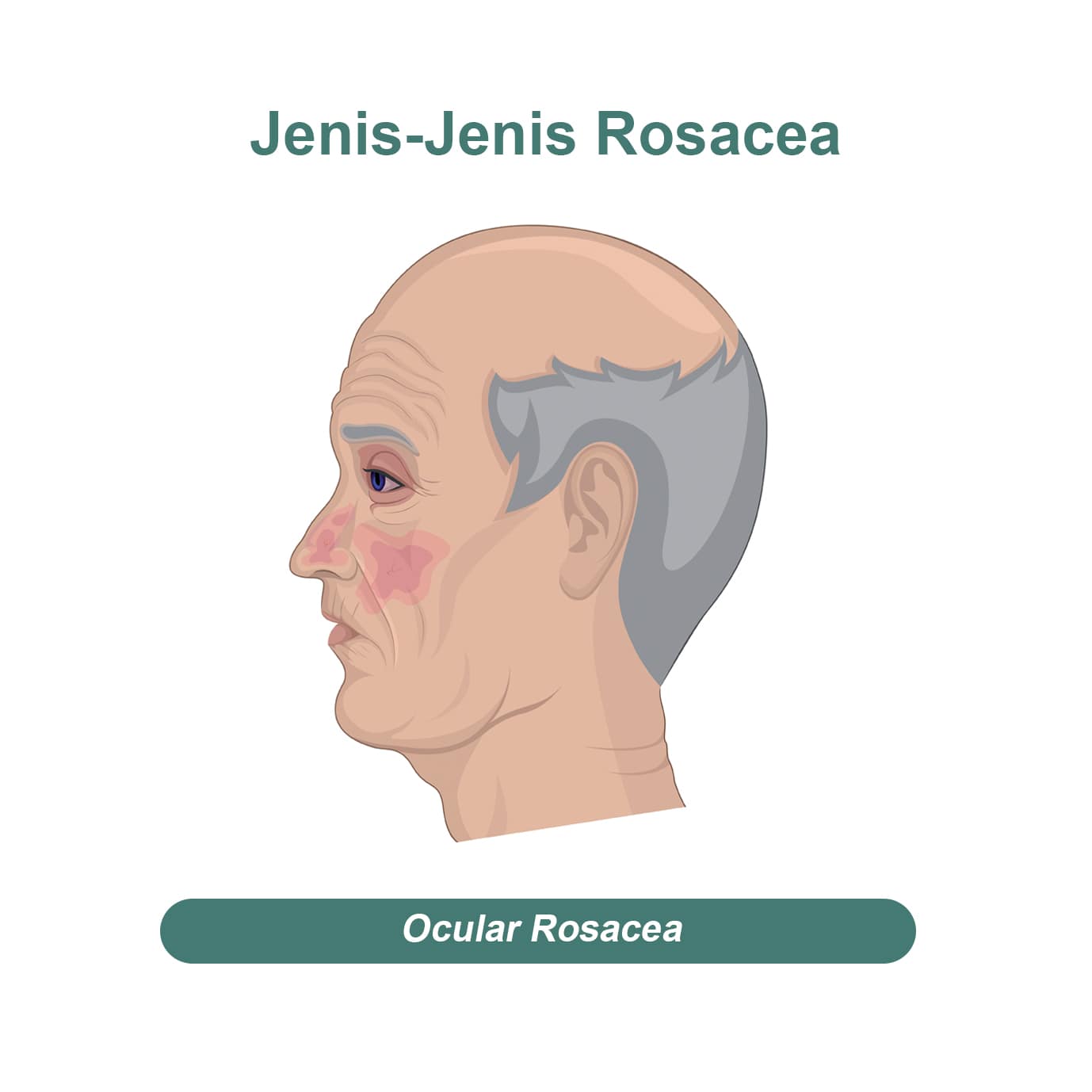 jenis rosacea - ocular rosacea