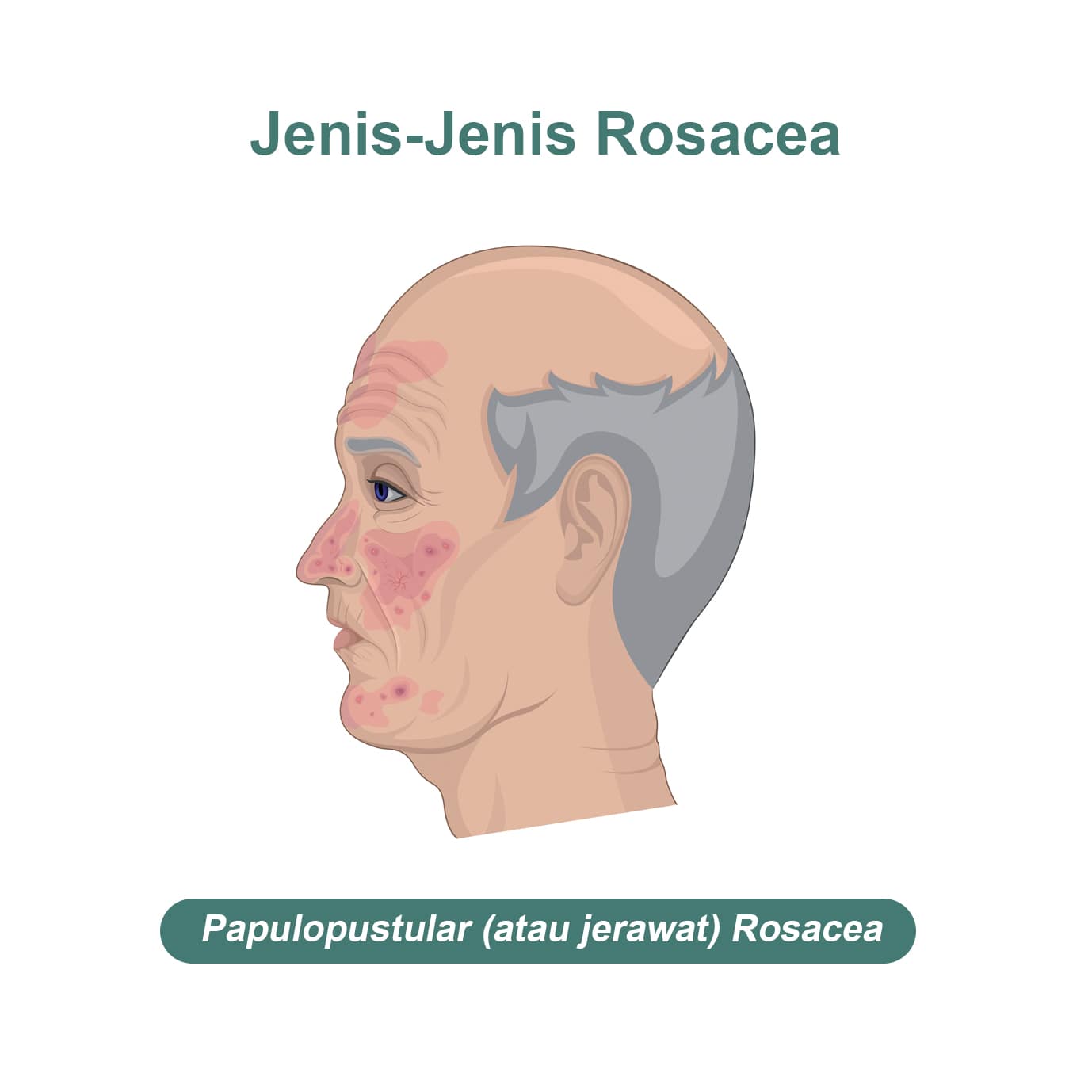 Jenis rosacea - papulopustular (jerawat) rosacea