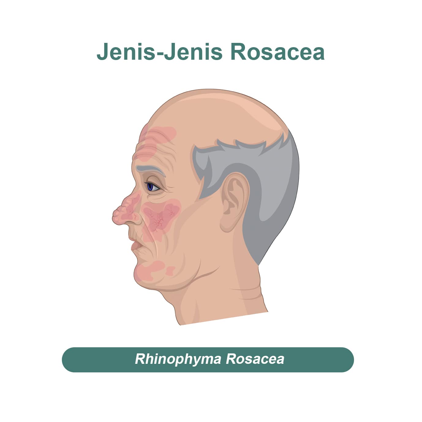 Jenis rosacea - rhinophyma rosacea