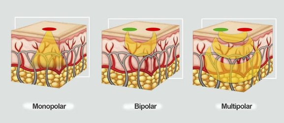 jenis-jenis radiofrekuensi