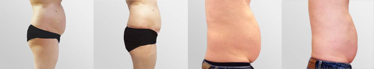 ReduStim-before-after