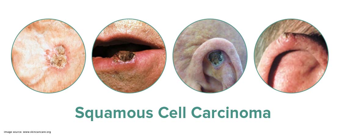 Squamous Cell Carcinoma
