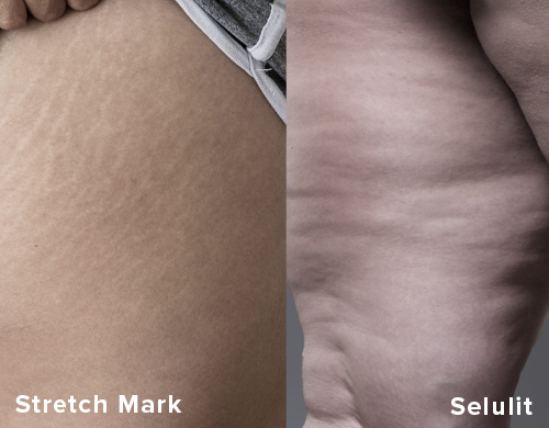 stretch mark vs selulit