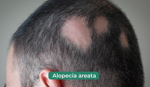 alopecia areata