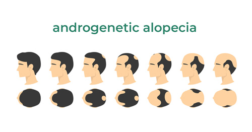 androgenetic alopecia