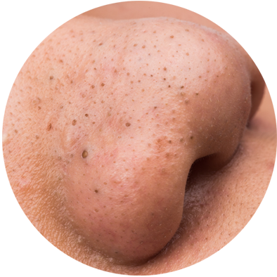 cara menghilangkan komedo hitam