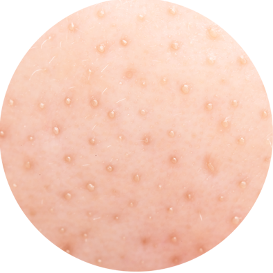 penyebab komedo putih