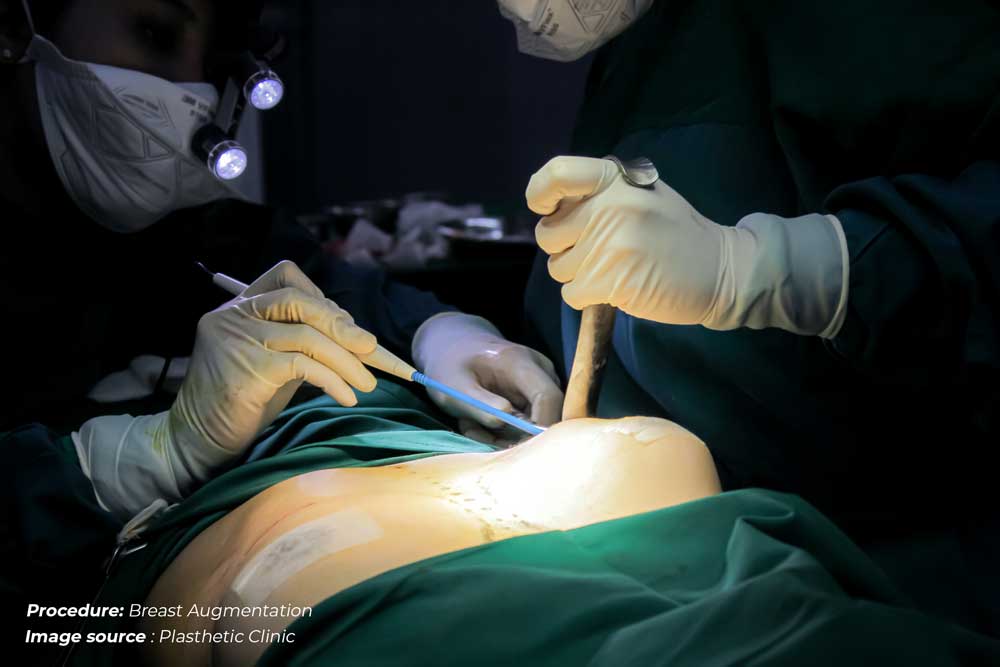 Breast-augmentation.2.jpg