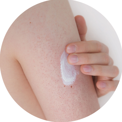 cara-mencegah-keratosis-pilaris.png
