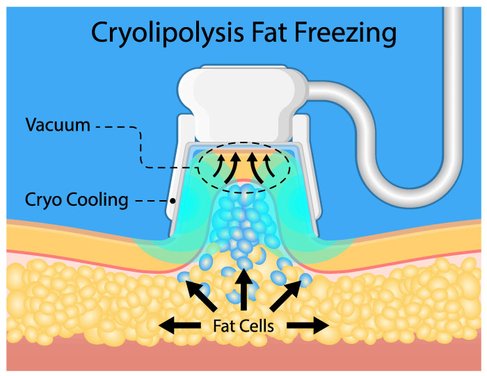 cryolipolisis