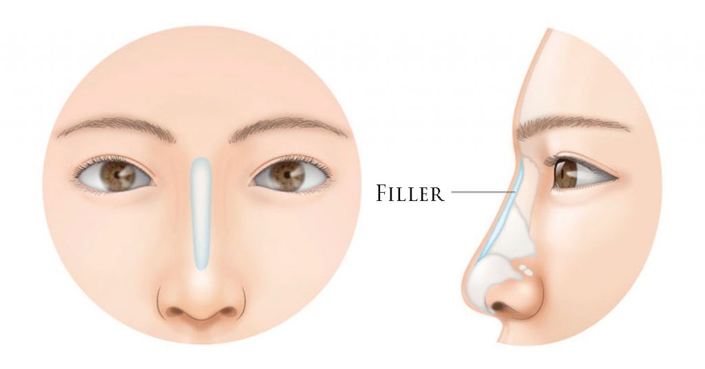 apa itu filler hidung
