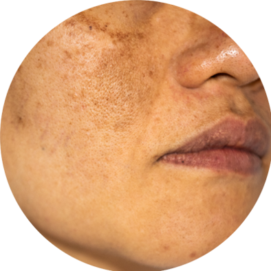 gyperpigmentation