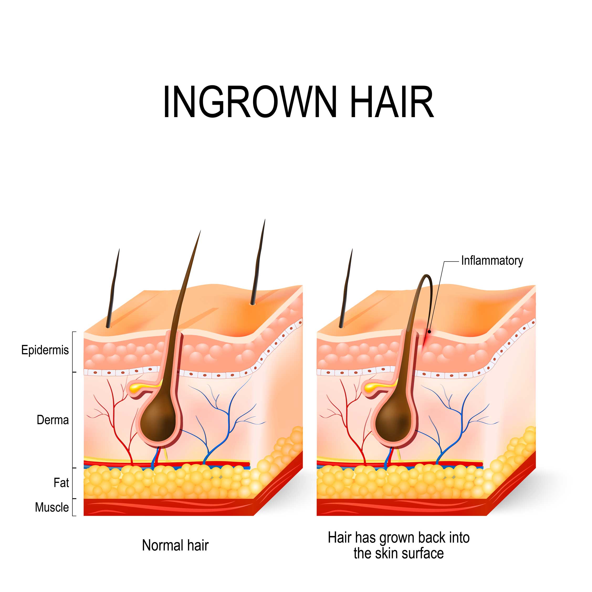 ingrown-hair-jerawat-di-ketiak