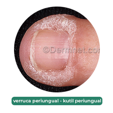 kutil periungual