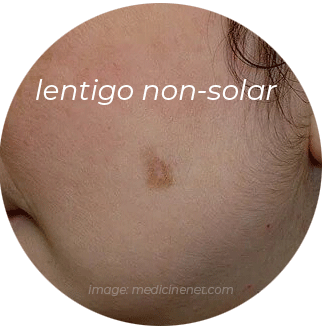 lentigo non solar