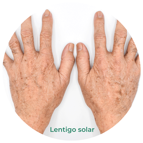 lentigo solar