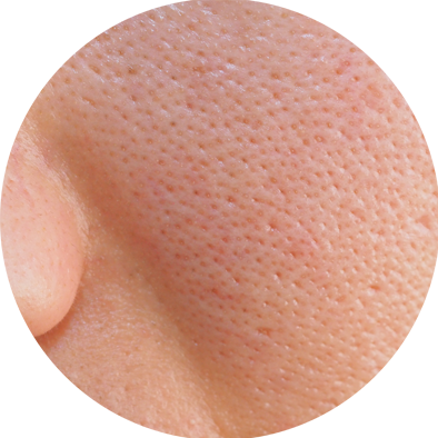 manfaat-pori-pori-besar-xela-rederm.png