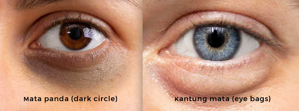 perbedaan mata panda dan kantung mata