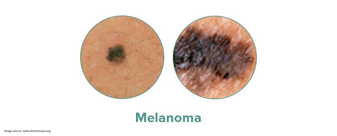 melanoma