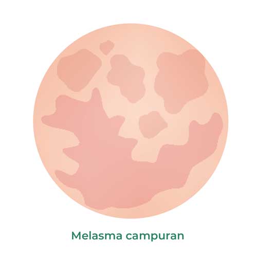melasma campuran