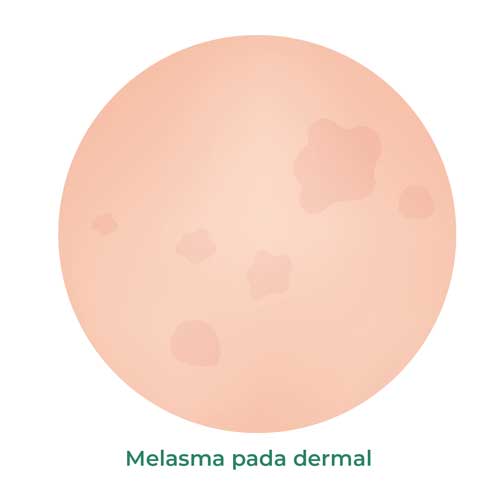 melasma pada dermal
