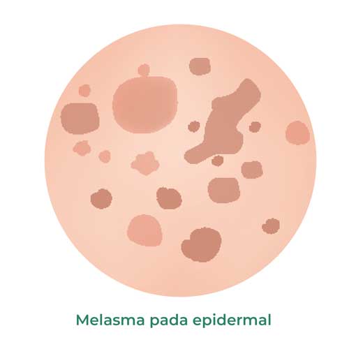 melasma pada epidermal