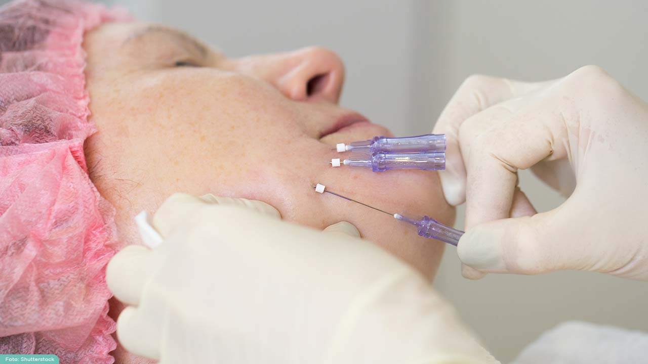 metode-tanam-benang-heystetik