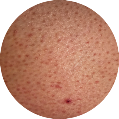 penyebab-keratosis-pilaris.png
