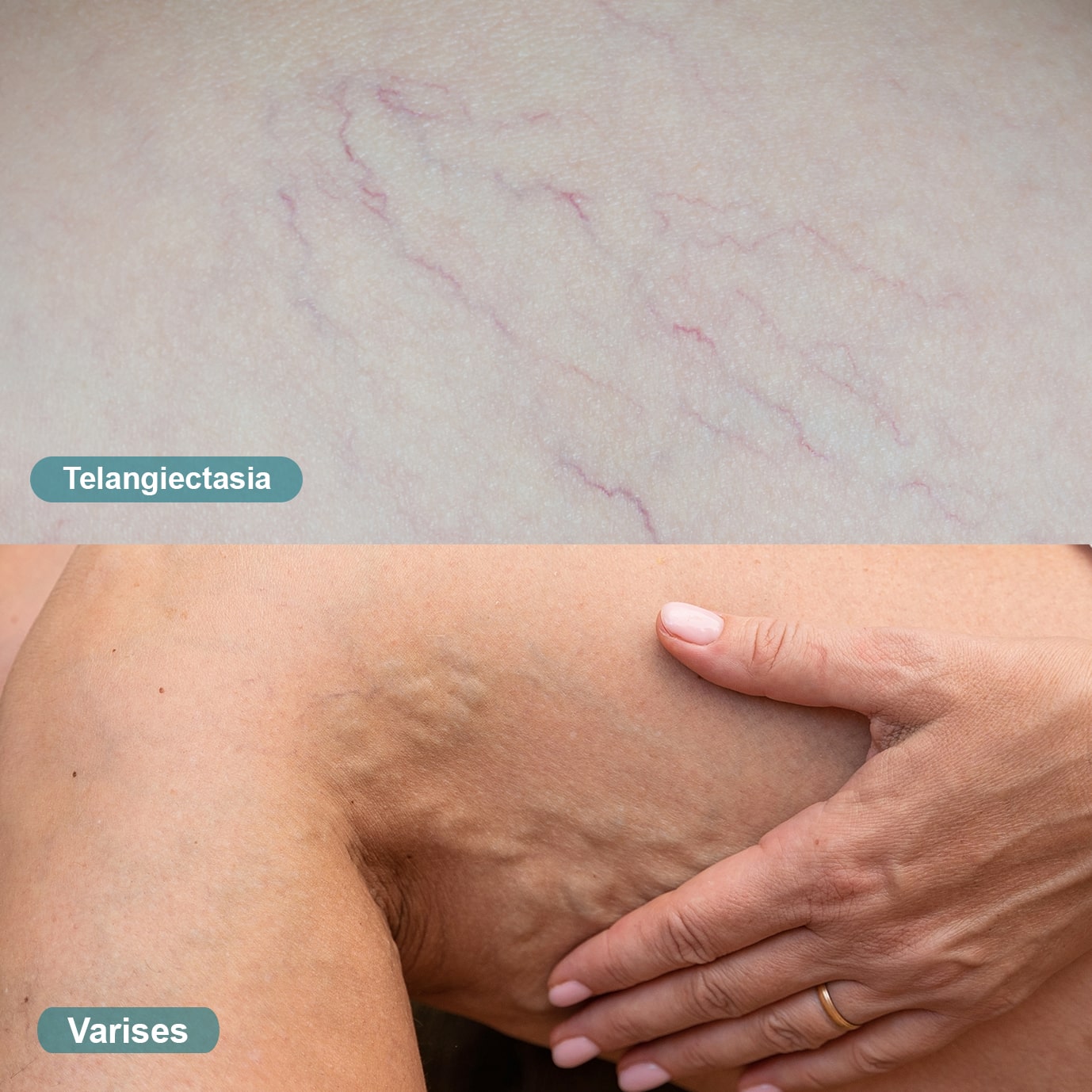 Perbedaan telangiectasia dan varises