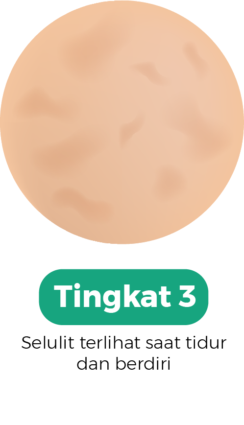selulit tingkat 3