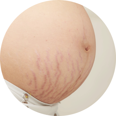 penyebab stretch mark adalah