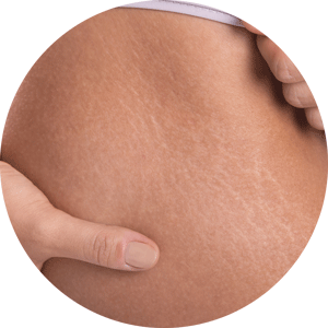 cara menghilangkan stretch mark