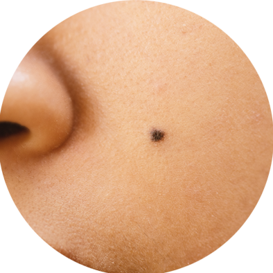 cara menghilangkan tahi lalat