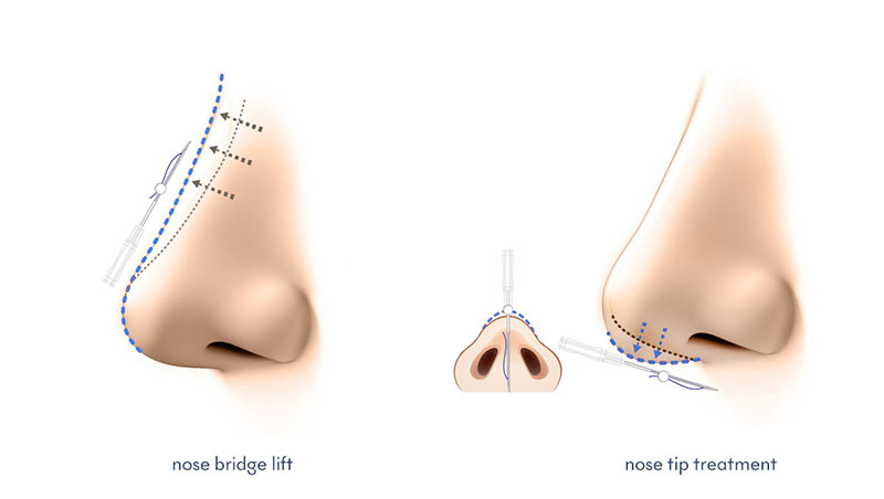 apa itu tanam benang