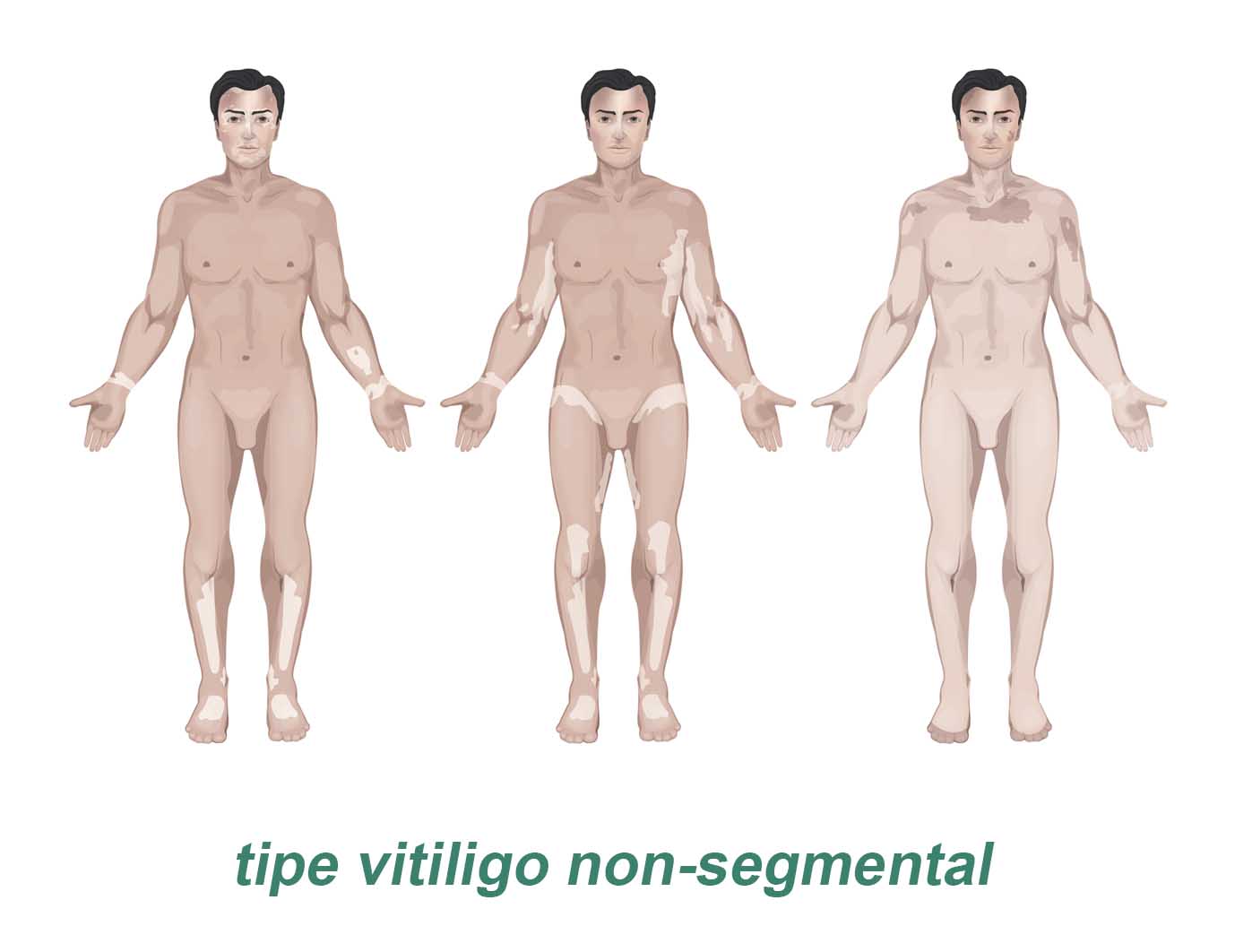 tipe vitiligo non segmental