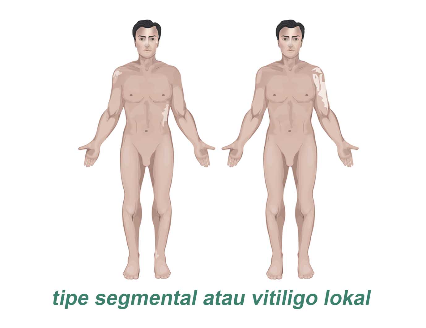 tipe vitiligo segmental atau vitiligo lokal
