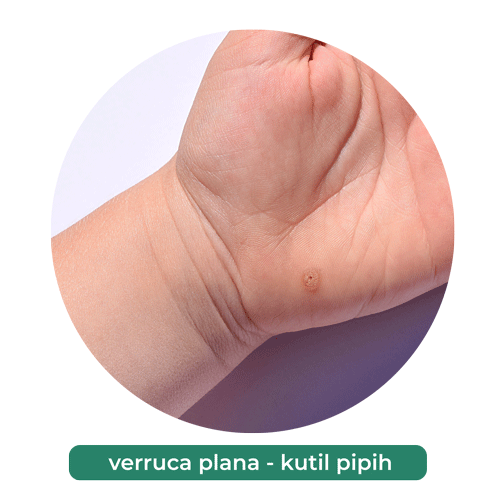 verruca plana-kutil pipih