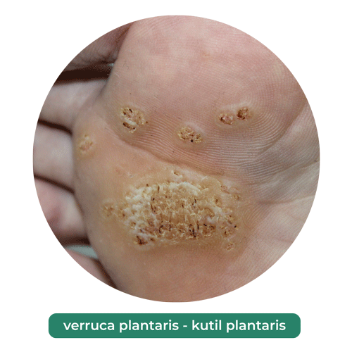verruca plantari -kutil plantaris