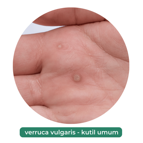 verruca vulgaris - kutil umum